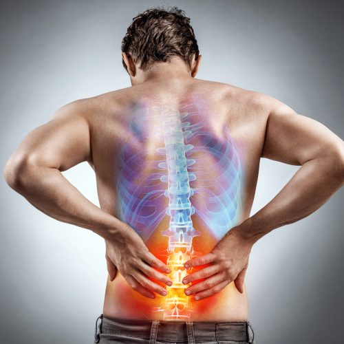 Chronic Back Pain Due to Herniated Disc