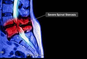 Spinal Stenosis | Disc Clinic BC