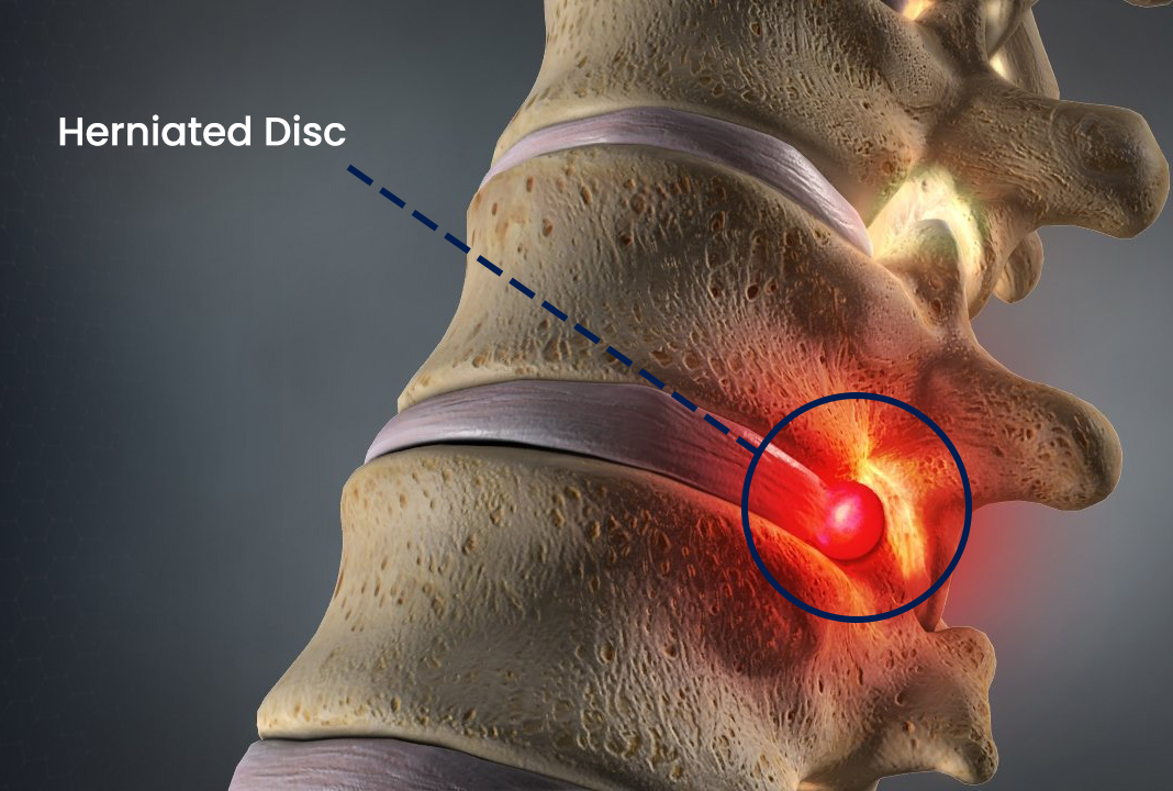 Disc Clinic BC | Computerized Disc Rehydration Now Offered at Disc ...